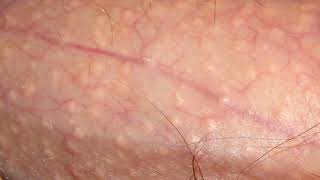 Learn about fordyce spots  what is adnexa [upl. by Allimac250]