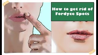 Fordyce Spots on Lips – Treatment How to get rid of them [upl. by Westberg]