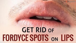 12 Ways To Get Rid Of Fordyce Spots On Lips  Healthspectra [upl. by Menard]