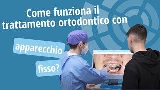 Trattamento ortodontico con apparecchio fisso come funziona  Studio Ortodontico Cocconi Rapa [upl. by Cullan161]