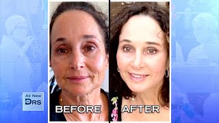 See Woman’s Incredible Before and After Facial Rejuvenation [upl. by Schuster93]