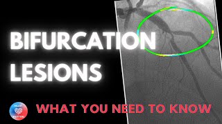 Bifurcation Coronary Lesions [upl. by Jew]