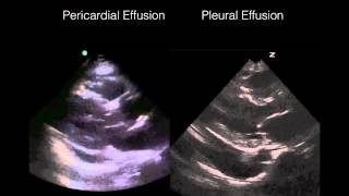 Cardiac Ultrasound Pericardial vs Pleural effusion [upl. by Katherine]