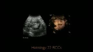 ultrasound in Renal Diseases [upl. by Tyrrell]