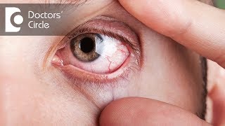 What causes visible red fine lines in eyes  Dr Elankumaran P [upl. by Idak]