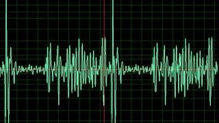 Mitral Stenosis slow [upl. by Lledrev]