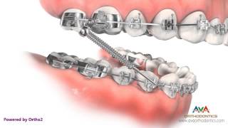 Orthodontic Treatment for Overjet Overbite  Forsus Appliance [upl. by Rudin127]