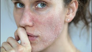 HARD WATER AND YOUR SKIN HOW TO DEAL WITH IT DR DRAY [upl. by Madel96]