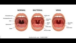 Pharyngitis Part 1 Viral Pharyngitis [upl. by Mcripley]