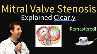 Mitral Valve Stenosis Diagnosis Treatment Pathophysiology [upl. by Wyn]