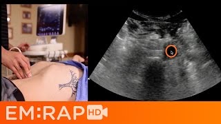 Ultrasound of Abdominal Aortic Aneurysm AAA [upl. by Meingolda]