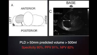 Estimate Pleural Effusion Volume [upl. by Myrt810]