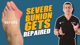 HORRIBLE Bunion Fixed footsurgeon footdoctor [upl. by Ligetti21]