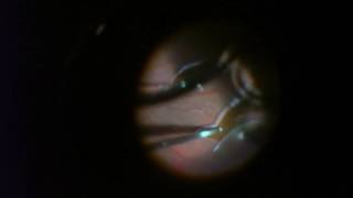 Eye Injections for Branch Retinal Vein Occlusion BRVO [upl. by Delora]