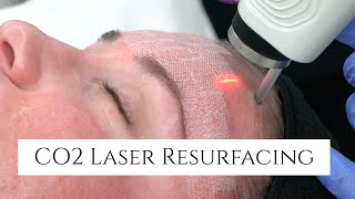 CO2 Laser Facial Rejuvenation  Fix Fine Lines and Wrinkles  Fix Sun Damage  Fix Stretch Marks [upl. by Rheinlander109]