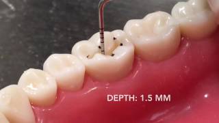 Class I Amalgam Cavity Preparation amp Restoration [upl. by Jezabel]