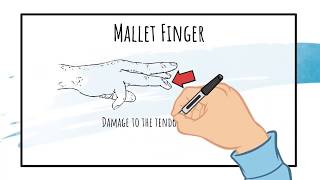 Mallet Finger Treatment EVERYTHING YOU NEED TO KNOW TO SELF TREAT [upl. by Noskcaj]