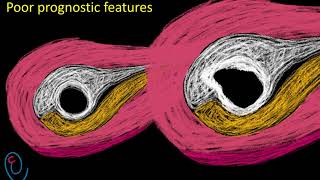 Early pregnancy ultrasound explained  GS  YS and FP [upl. by Sonstrom]