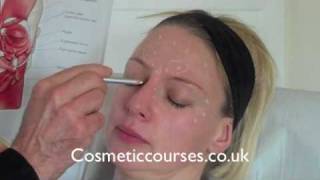 Botox training 2 Where to place Botox injections [upl. by Inan]