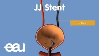 Behandlung von Nieren und Harnleitersteinen JJstent [upl. by Aztirak]