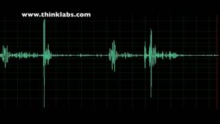 Pulmonary Stenosis mild [upl. by Aihsemek312]