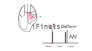 Mitral stenosis murmur [upl. by Ahseneuq]