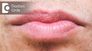 Treatment options for white spots in lips  Dr Rasya Dixit [upl. by Erej]