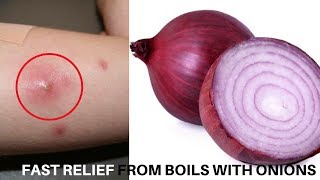 HOW TO TREAT BOILS EFFECTIVELY WITH ONIONS [upl. by Rima]