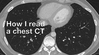 How I Read a Chest CT [upl. by Aiepoissac]