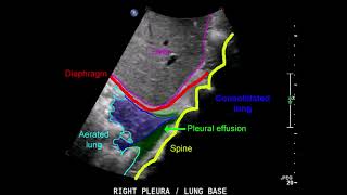 pleural effusion lung consolidation ultrasound [upl. by Everrs]