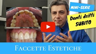 Denti dritti subito faccette estetiche [upl. by Mattland]