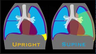 Pleural Effusion Explained by Prometheus Lionhart MD [upl. by Gelhar564]