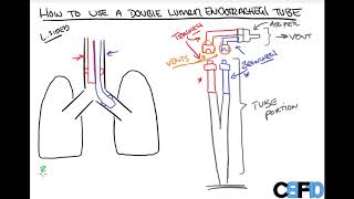 How to use a Double Lumen Endotracheal Tube [upl. by Noskcaj838]