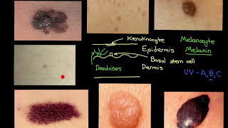 Superficial Spreading Melanoma  Histopathology [upl. by Anselmi12]