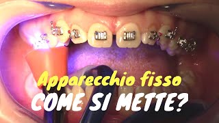 Come si mette lapparecchio fisso [upl. by Aivad]