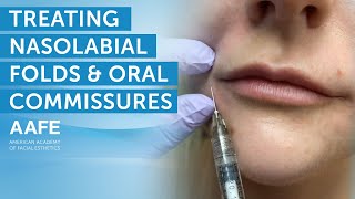 Using Dermal Fillers to Fill and Smooth Smile Lines  AAFE [upl. by Hatti]