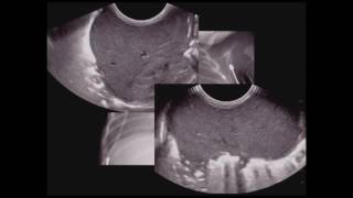 Pediatric Chest Ultrasound [upl. by Erdnaed]