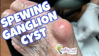 Spewing Ganglion Cyst [upl. by Alletnahs211]