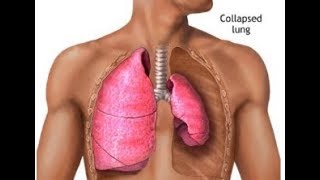 What is Lung Atelectasis Collapse [upl. by Ardnoyek]