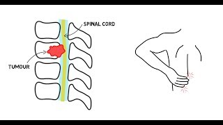 Spinal Cord Compression [upl. by Allred]