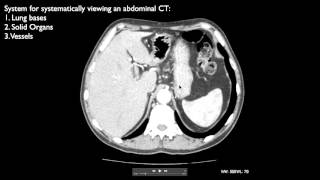 How to interpret an abdominal CT [upl. by Libbna63]