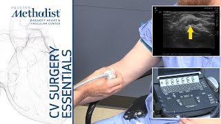 Vessel Mapping for Dialysis Access Eric Peden MD [upl. by Guntar929]