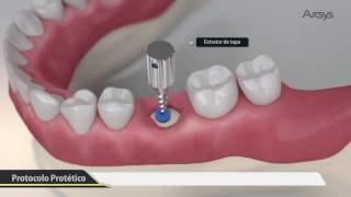 Procedimento Cirúrgico 3D  Arcsys Sistema de Implantes  FGM [upl. by Doti]