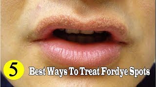 5 Best Ways to Remove Fordyce Spots Naturally at Home YouTube [upl. by Oretos]