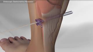 Endoscopic Gastrocnemius Recession [upl. by Oigolue]