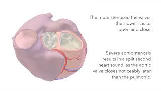 Aortic Stenosis  Murmur Sound amp Animation [upl. by Negah]