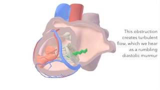 Mitral Stenosis  sound amp animation [upl. by Latrice]