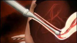 Early Pregnancy Failure A simplified Ultrasound Approach [upl. by Nofpets]