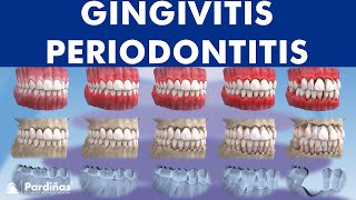 Gingivitis and Periodontitis  Evolution © [upl. by Gronseth]