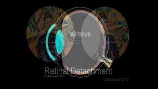 Retinal Detachment [upl. by Maryjo632]